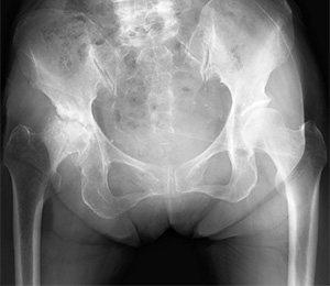 人工股関節手術 術前 X線写真